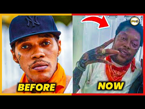 Why Is Vybz Kartel's Face So Swollen